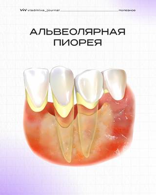 Альвеолярная пиорея: рекомендации профессора Лемецкой.